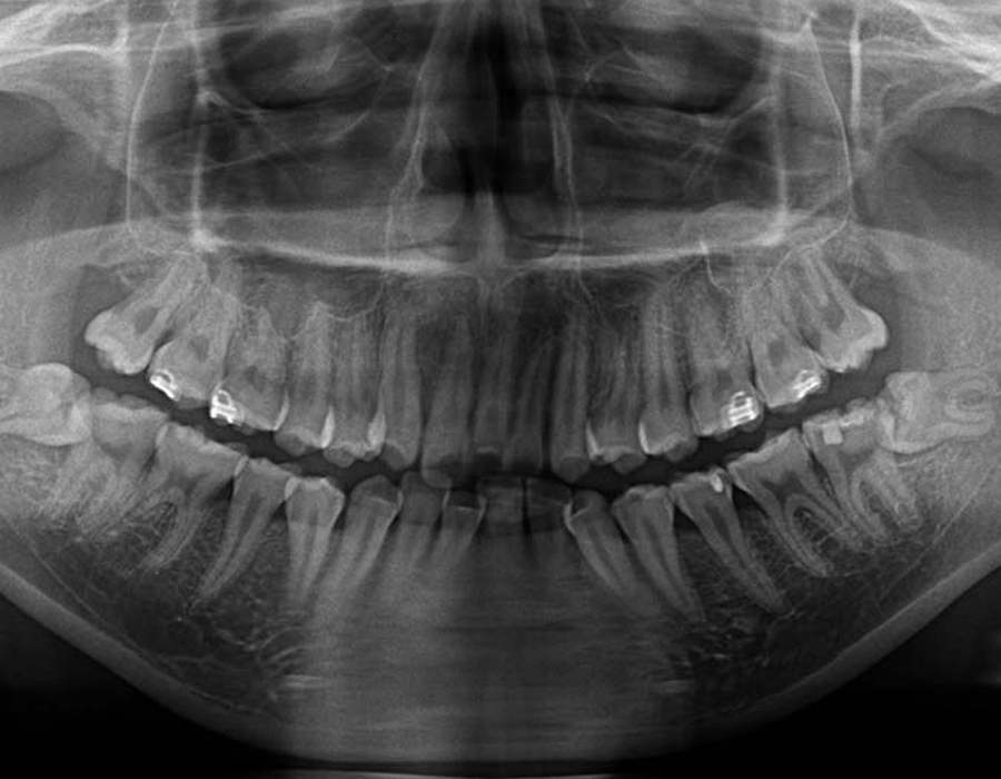 親知らず専門外来症例2